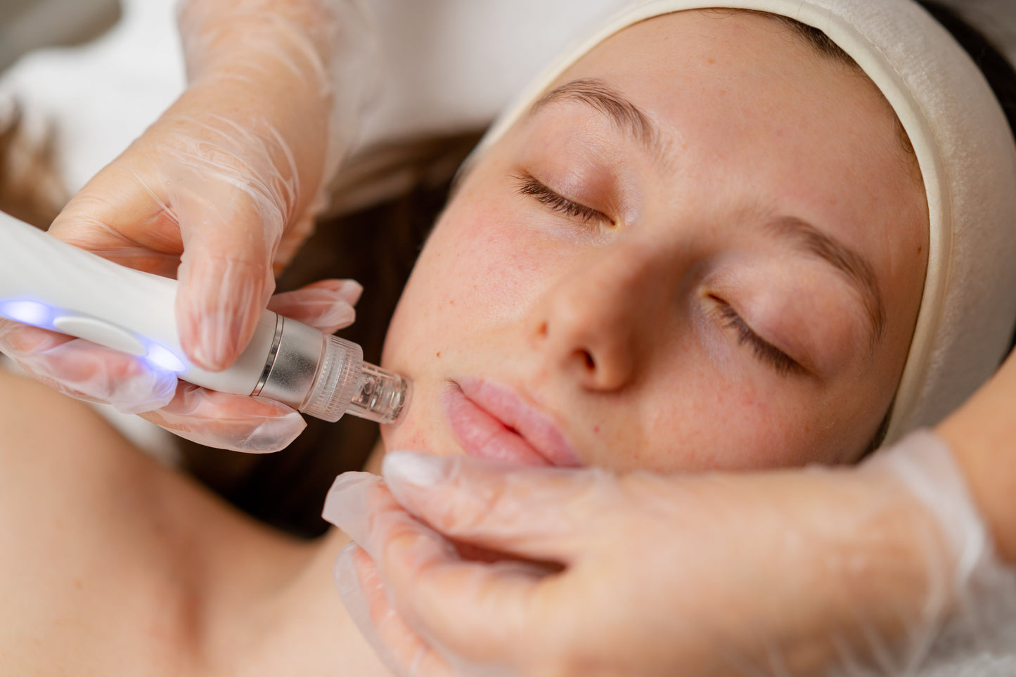 Skin Needling with Skin Booster Salmon DNA – Pack of 3